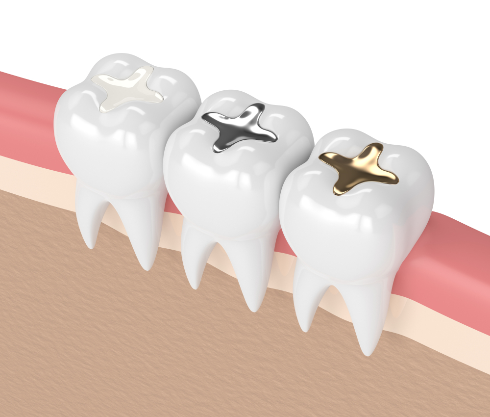 What are the different types of dental fillings?