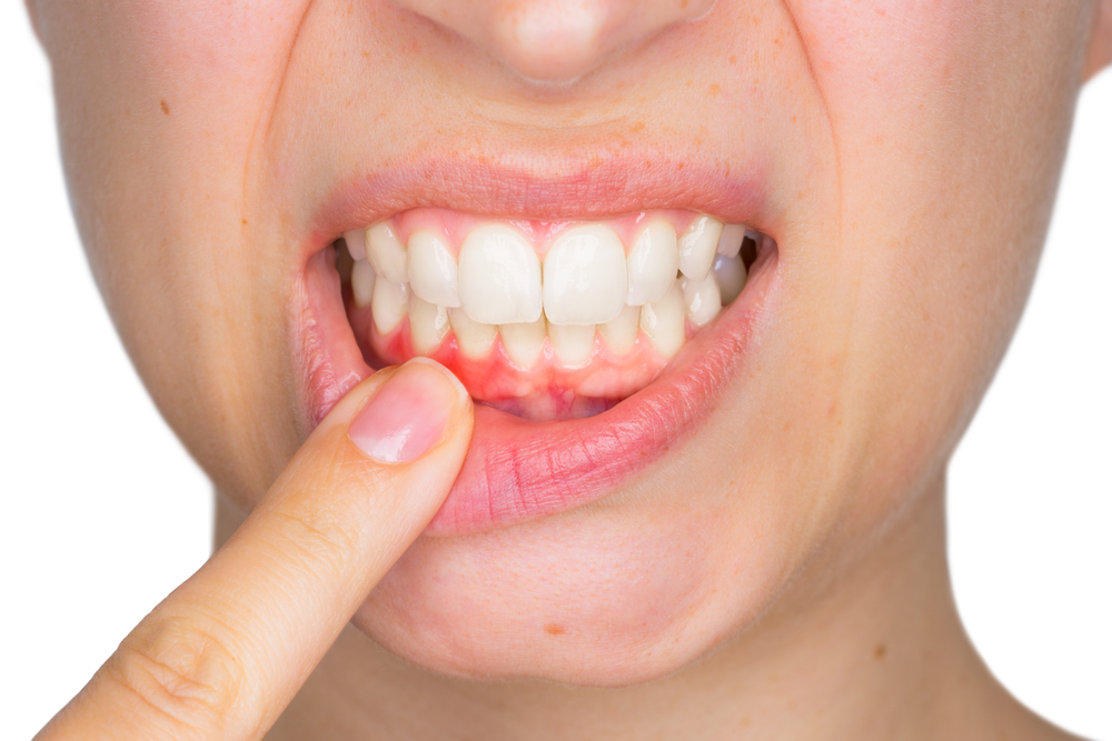 The Cons of Gum Disease, and When to get Treated