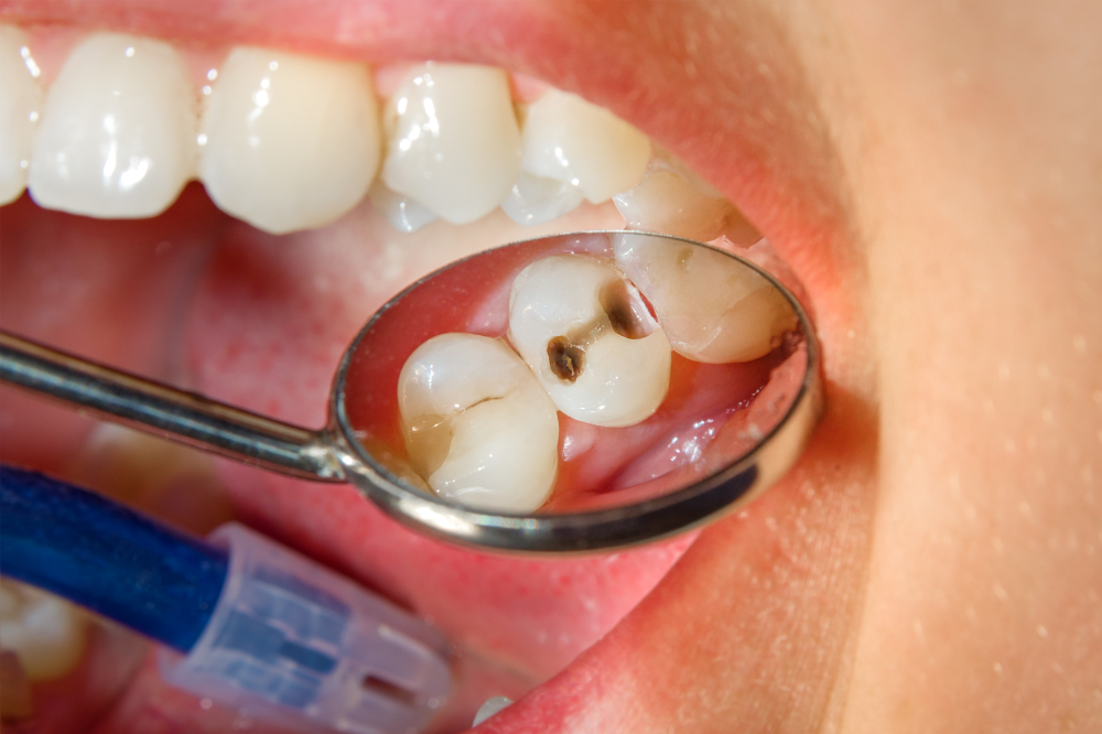 What are Cavities?