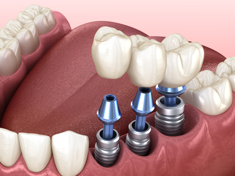 Dental Implants Vs. Dentures